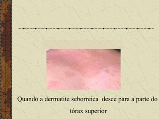 Quando a dermatite seborreica desce para a parte do
tórax superior
 