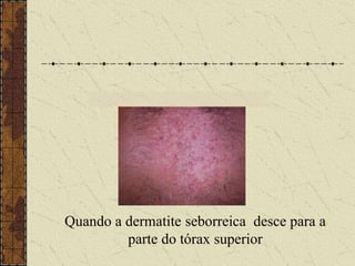 Quando a dermatite seborreica desce para a
parte do tórax superior
 