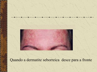 Quando a dermatite seborreica desce para a fronte
 