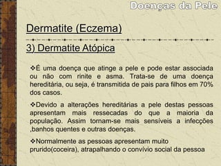 Dermatite (Eczema)
3) Dermatite Atópica
É uma doença que atinge a pele e pode estar associada
ou não com rinite e asma. Trata-se de uma doença
hereditária, ou seja, é transmitida de pais para filhos em 70%
dos casos.
Devido a alterações hereditárias a pele destas pessoas
apresentam mais ressecadas do que a maioria da
população. Assim tornam-se mais sensíveis a infecções
,banhos quentes e outras doenças.
Normalmente as pessoas apresentam muito
prurido(coceira), atrapalhando o convívio social da pessoa
 