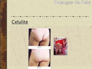 Celulite
Ou fibro edema gelóide (FEG), o conceito mais aceito
atualmente para descrever o quadro. A celulite é
caracterizada por um edema não-inflamatório do tecido
conjuntivo subcutâneo, que se inicia com um mal
funcionamento do sistema circulatório e das consecutivas
transformações do tecido causadas por alterações
hormonais, sedentarismo, alimentação inadequada, tensão
pré-menstrual, hereditariedade, problemas circulatórios,
uso de anticoncepcionais, dentre outros.
 