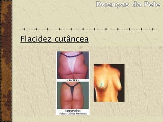 Flacidez cutâncea
É causada por deficiência na produção de fibras
elásticas, envelhecimento, efeito sanfona, emagrecimento
muito rápido, gestações e má alimentação.
Não se resolve na academia.
os tratamentos com substâncias injetáveis estão
indicadas para estimular a produção de fibra elástica.
 