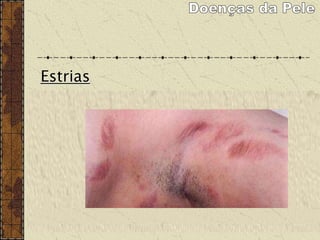 Estrias
As estrias atróficas são lesões decorrentes da
degeneração das fibras elásticas da pele que ocorrem por
sua distensão exagerada ou devido a alterações
hormonais.
É comum o surgimento durante a puberdade em
decorrência do crescimento acelerado nesta fase da vida e
também na obesidade e na gravidez. Atinge os dois sexos
porém é mais frequente no sexo feminino.
 