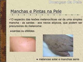 Manchas e Pintas na Pele
Certas formas de câncer podem ter sua origem
em pintas ou manchas da pele.
Sabe-se que 50% dos melanomas podem ter origem
nas pintas ou manchas escuras.
O espectro das lesões melanocíticas vai de uma simples
mancha - as sardas - aos nevos atípicos, que podem ser
precursores do melanoma:
sardas ou efélides
 melanose solar e manchas senis
 