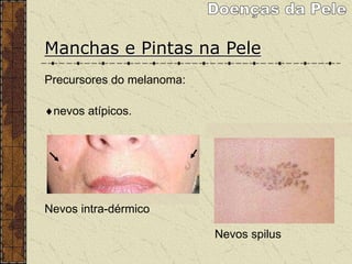Manchas e Pintas na Pele
Precursores do melanoma:
nevos atípicos.
Nevos intra-dérmico
Nevos spilus
 