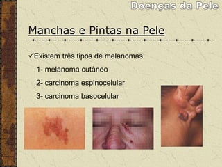 Manchas e Pintas na Pele
Existem três tipos de melanomas:
1- melanoma cutâneo
2- carcinoma espinocelular
3- carcinoma basocelular
 