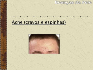 Acne (cravos e espinhas)
 