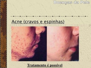 Acne (cravos e espinhas)
Acne de I grau
apenas cravos, sem
lesões inflamatórias
(espinhas).
Acne de II grau
cravos e "espinhas"
pequenas, como
pequenas lesões
inflamadas e pontos
amarelos de pus
(pústulas).
Acne de II grau
cravos e "espinhas"
pequenas, como
pequenas lesões
inflamadas e pontos
amarelos de pus
(pústulas).
Acne de III grau
cravos, "espinhas"
pequenas e lesões
maiores, mais
profundas, dolorosas,
avermelhadas e bem
inflamadas (cistos).
Acne de IV grau
cravos, "espinhas"
pequenas e grandes
lesões císticas,
comunicantes (acne
conglobata), com
muita inflamação e
aspecto desfigurante.
Tratamento é possível
 
