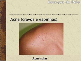 Acne (cravos e espinhas)
Acne solar
 