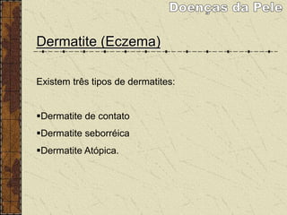 Dermatite (Eczema)
Existem três tipos de dermatites:
Dermatite de contato
Dermatite seborréica
Dermatite Atópica.
 