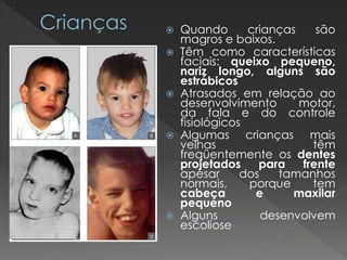  Quando crianças são 
magros e baixos. 
 Têm como características 
faciais: queixo pequeno, 
nariz longo, alguns são 
estrábicos 
 Atrasados em relação ao 
desenvolvimento motor, 
da fala e do controle 
fisiológicos 
 Algumas crianças mais 
velhas têm 
freqüentemente os dentes 
projetados para frente 
apesar dos tamanhos 
normais, porque tem 
cabeça e maxilar 
pequeno 
 Alguns desenvolvem 
escoliose 
 