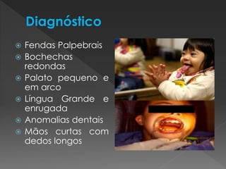  Fendas Palpebrais 
 Bochechas 
redondas 
 Palato pequeno e 
em arco 
 Língua Grande e 
enrugada 
 Anomalias dentais 
 Mãos curtas com 
dedos longos 
 