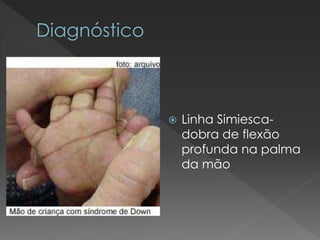  Linha Simiesca-dobra 
de flexão 
profunda na palma 
da mão 
 