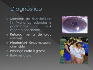  Manchas de Brushfield na 
íris (Manchas redondas e 
pontilhadas na íris 
aspecto pontilhado 
 Retardo mental de grau 
variável 
 Hipotonia tônus muscular 
diminuído 
 Pescoço curto e grosso 
 Baixa estatura 
 