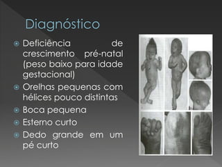  Deficiência de 
crescimento pré-natal 
(peso baixo para idade 
gestacional) 
 Orelhas pequenas com 
hélices pouco distintas 
 Boca pequena 
 Esterno curto 
 Dedo grande em um 
pé curto 
 