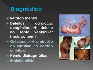  Retardo mental 
 Defeitos cardíacos 
congênitos  defeito 
no septo ventricular 
(mais comum) 
 Onfalocele  protrusão 
do intestino no cordão 
umbilical 
 Hérnia diafragmática 
 Espinha bífida 
 