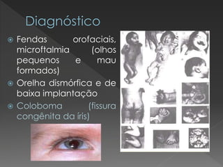  Fendas orofaciais, 
microftalmia (olhos 
pequenos e mau 
formados) 
 Orelha dismórfica e de 
baixa implantação 
 Coloboma (fissura 
congênita da íris) 
 