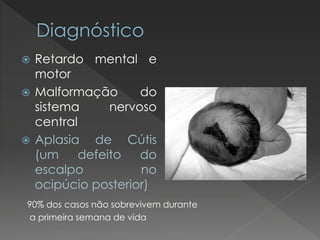  Retardo mental e 
motor 
 Malformação do 
sistema nervoso 
central 
 Aplasia de Cútis 
(um defeito do 
escalpo no 
ocipúcio posterior) 
90% dos casos não sobrevivem durante 
a primeira semana de vida 
 