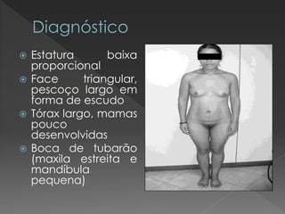  Estatura baixa 
proporcional 
 Face triangular, 
pescoço largo em 
forma de escudo 
 Tórax largo, mamas 
pouco 
desenvolvidas 
 Boca de tubarão 
(maxila estreita e 
mandíbula 
pequena) 
 