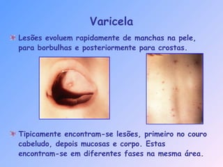 Varicela
Lesões evoluem rapidamente de manchas na pele,
para borbulhas e posteriormente para crostas.
Tipicamente encontram-se lesões, primeiro no couro
cabeludo, depois mucosas e corpo. Estas
encontram-se em diferentes fases na mesma área.
 