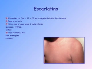 Alterações da Pele – 12 a 72 horas depois do inicio dos sintomas
Áspera ao tacto
Início nas pregas, onde é mais intenso
(pescoço, virilhas,
axilas)
Face vermelha, mas
sem alterações
cutâneas
Escarlatina
 