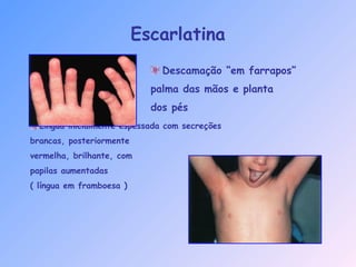 Língua inicialmente espessada com secreções
brancas, posteriormente
vermelha, brilhante, com
papilas aumentadas
( língua em framboesa )
Escarlatina
Descamação “em farrapos”
palma das mãos e planta
dos pés
 