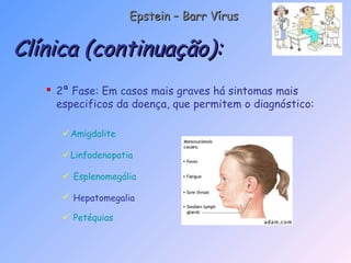  2ª Fase: Em casos mais graves há sintomas mais
especificos da doença, que permitem o diagnóstico:
Amigdalite
Linfadenopatia
 Esplenomegália
 Hepatomegalia
 Petéquias
Clínica (continuação):Clínica (continuação):
Epstein – Barr VírusEpstein – Barr Vírus
 