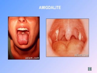 AMIGDALITE
 