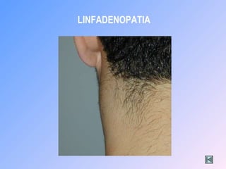 LINFADENOPATIA
 