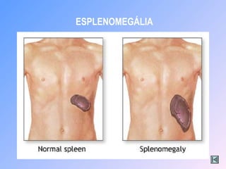 ESPLENOMEGÁLIA
 