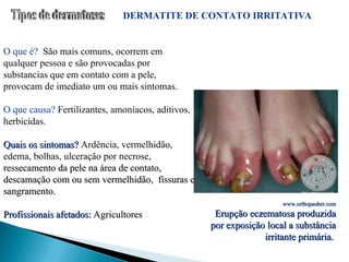 DERMATITE DE CONTATO IRRITATIVA
O que é? São mais comuns, ocorrem em
qualquer pessoa e são provocadas por
substancias que em contato com a pele,
provocam de imediato um ou mais sintomas.
O que causa? Fertilizantes, amoníacos, aditivos,
herbicidas.
Quais os sintomas?
Quais os sintomas? Ardência, vermelhidão,
edema, bolhas, ulceração por necrose,
ressecamento da pele na área de contato,
ressecamento da pele na área de contato,
descamação com ou sem vermelhidão, fissuras e
descamação com ou sem vermelhidão, fissuras e
sangramento.
sangramento.
Profissionais afetados:
Profissionais afetados: Agricultores
Agricultores
www.orthopauher.com
www.orthopauher.com
Erupção eczematosa produzida
Erupção eczematosa produzida
por exposição local a substância
por exposição local a substância
irritante primária.
irritante primária.
 