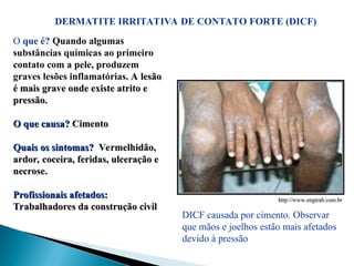 DERMATITE IRRITATIVA DE CONTATO FORTE (DICF)
O que é? Quando algumas
substâncias químicas ao primeiro
contato com a pele, produzem
graves lesões inflamatórias. A lesão
A lesão
é mais grave onde existe atrito e
é mais grave onde existe atrito e
pressão.
pressão.
O que causa?
O que causa? Cimento
Cimento
Quais os sintomas?
Quais os sintomas? Vermelhidão,
Vermelhidão,
ardor, coceira, feridas, ulceração e
ardor, coceira, feridas, ulceração e
necrose.
necrose.
Profissionais afetados:
Profissionais afetados:
Trabalhadores da construção civil
Trabalhadores da construção civil
http://www.engtrab.com.br
http://www.engtrab.com.br
DICF causada por cimento. Observar
que mãos e joelhos estão mais afetados
devido à pressão
 