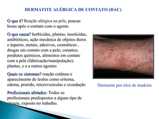 DERMATITE ALÉRGICA DE CONTATO (DAC)
Dermatite por óleo de madeira
O que é?
O que é? Reação alérgica na pele, poucas
poucas
horas após o contato com o agente.
horas após o contato com o agente.
O que causa?
O que causa? herbicidas, plantas, inseticidas,
herbicidas, plantas, inseticidas,
antibióticos, ação mecânica de objetos duros
antibióticos, ação mecânica de objetos duros
e ásperos, metais, adesivos, cosméticos ,
e ásperos, metais, adesivos, cosméticos ,
drogas em contato com a pele; corantes;
drogas em contato com a pele; corantes;
produtos químicos, alimentos em contato
produtos químicos, alimentos em contato
com a pele (fabricação/manipulação);
com a pele (fabricação/manipulação);
plantas, e a a outros agentes
plantas, e a a outros agentes
Quais os sintomas?
Quais os sintomas? reação cutânea o
reação cutânea o
aparecimento de lesões como eritema,
aparecimento de lesões como eritema,
edema, prurido, microvesículas e exsudação
edema, prurido, microvesículas e exsudação
Profissionais afetados:
Profissionais afetados: Todos os
Todos os
profissionais predispostos a algum tipo de
profissionais predispostos a algum tipo de
alergia, exposto no trabalho.
alergia, exposto no trabalho.
 