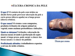 ÚLCERA CRONICA DA PELE
http://www.scielo.br
http://www.scielo.br
O que é?
O que é? O contato da pele com ácidos ou
álcalis fortes pode provocar ulceração da pele a
curto prazo (úlcera aguda) ou a longo prazo
(úlcera crônica).
O que causa?
O que causa? O cromo e seus compostos,
O cromo e seus compostos,
produtos irritantes de origem animal ou
produtos irritantes de origem animal ou
vegetal, como enzimas proteolíticas e infecções.
vegetal, como enzimas proteolíticas e infecções.
Quais os sintomas?
Quais os sintomas? irritação e ulceração da
irritação e ulceração da
mucosa nasal, levando à perfuração do septo
mucosa nasal, levando à perfuração do septo
nasal. A
nasal. A longo prazo, pode surgir o câncer das
fossas nasais e o câncer de pulmão
Profissionais afetados:
Profissionais afetados: trabalhadores expostos
trabalhadores expostos
a névoas de ácido crômico.
a névoas de ácido crômico.
Úlcera por cromo
Úlcera por cromo
 