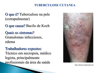 TUBERCULOSE CUTANEA
http://dermis.multimedica.de
http://dermis.multimedica.de
O que é?
O que é? Tuberculose na pele
Tuberculose na pele
(extrapulmonar)
(extrapulmonar)
O que causa?
O que causa? Bacilo de Koch
Bacilo de Koch
Quais os sintomas?
Quais os sintomas?
Granulomas infecciosos,
Granulomas infecciosos,
edema
edema
Trabalhadores expostos
Trabalhadores expostos:
:
Técnico em necropsia, médico
Técnico em necropsia, médico
legista, principalmente
legista, principalmente
profissionais da área da saúde
profissionais da área da saúde
 