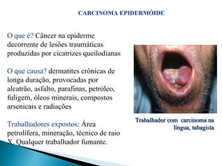 http://www.dermato.med.br/publicacoes
http://www.dermato.med.br/publicacoes
Trabalhador com carcinoma na
Trabalhador com carcinoma na
língua, tabagista
língua, tabagista
O que é? Câncer na epiderme
decorrente de lesões traumáticas
produzidas por cicatrizes queilodianas
O que causa? dermatites crônicas de
longa duração, provocadas por
alcatrão, asfalto, parafinas, petróleo,
fuligem, óleos minerais, compostos
arsenicais e radiações
Trabalhadores expostos: Área
petrolífera, mineração, técnico de raio
X. Qualquer trabalhador fumante.
CARCINOMA EPIDERMÓIDE
 