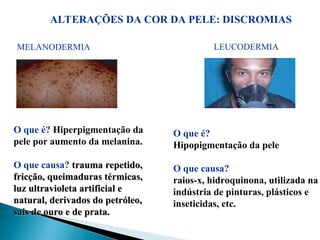 ALTERAÇÕES DA COR DA PELE: DISCROMIAS
MELANODERMIA LEUCODERMIA
O que é? Hiperpigmentação da
pele por aumento da melanina.
O que causa? trauma repetido,
trauma repetido,
fricção, queimaduras térmicas,
fricção, queimaduras térmicas,
luz ultravioleta artificial e
luz ultravioleta artificial e
natural, derivados do petróleo,
natural, derivados do petróleo,
sais de ouro e de prata.
sais de ouro e de prata.
O que é?
Hipopigmentação da pele
O que causa?
raios-x, hidroquinona, utilizada na
indústria de pinturas, plásticos e
inseticidas, etc.
 