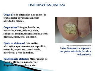 ONICOPATIAS (UNHAS)
http://www.medicinageriatrica.com.br
http://www.medicinageriatrica.com.br
Unha descamativa, espessa e
Unha descamativa, espessa e
com pouca aderência devido a
com pouca aderência devido a
onicomicose
onicomicose
O que é?
O que é? São alterações nas unhas do
São alterações nas unhas do
trabalhador agravadas em suas
trabalhador agravadas em suas
atividades diárias.
atividades diárias.
O que causa?
O que causa? fungos, leveduras,
fungos, leveduras,
bactérias, vírus, Ácidos, álcalis,
bactérias, vírus, Ácidos, álcalis,
solventes, resinas, traumatismos, atrito,
solventes, resinas, traumatismos, atrito,
pressão, calor, frio, umidade,
pressão, calor, frio, umidade,
Quais os sintomas?
Quais os sintomas? São muitas
São muitas
alterações, que ocorrem na superfície,
alterações, que ocorrem na superfície,
extensão, espessura, consistência,
extensão, espessura, consistência,
aderência, e cor da unhas.
aderência, e cor da unhas.
Profissionais afetados:
Profissionais afetados: Mineradores de
Mineradores de
carvão, Militares, nadadores e
carvão, Militares, nadadores e
desportistas, pescadores, etc.
desportistas, pescadores, etc.
 