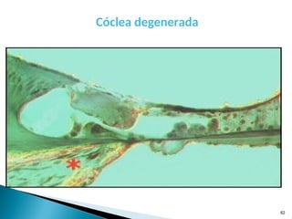 .
Cóclea degenerada
62
 