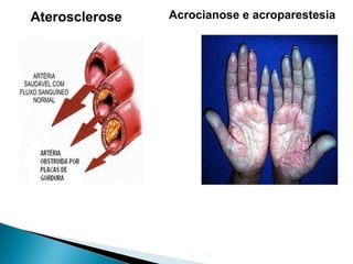 Aterosclerose Acrocianose e acroparestesia
 