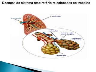 Doenças do sistema respiratório relacionadas ao trabalho
 