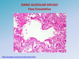 DANO ALVEOLAR DIFUSO
                         Fase Exsudativa




http://anatpat.unicamp.br/lamresp5.html
 