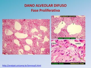 DANO ALVEOLAR DIFUSO
                         Fase Proliferativa




http://anatpat.unicamp.br/lamresp5.html
 