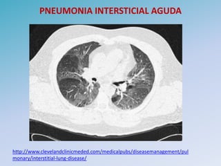 PNEUMONIA INTERSTICIAL AGUDA




http://www.clevelandclinicmeded.com/medicalpubs/diseasemanagement/pul
monary/interstitial-lung-disease/
 