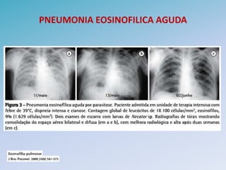 PNEUMONIA EOSINOFILICA AGUDA
 