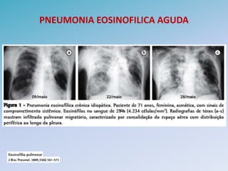 PNEUMONIA EOSINOFILICA AGUDA
 