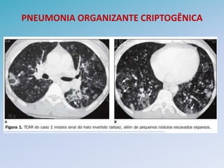 PNEUMONIA ORGANIZANTE CRIPTOGÊNICA
 