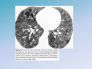 Doencas pulmonares difusas