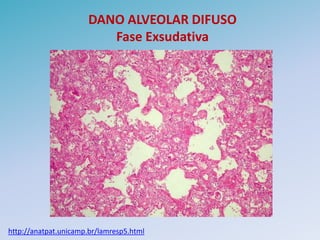 DANO ALVEOLAR DIFUSO
                         Fase Exsudativa




http://anatpat.unicamp.br/lamresp5.html
 