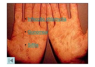 Doencas Sexualmente Transmissiveis